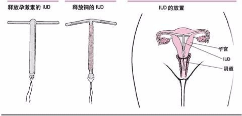 元宫型Cu365节育环安装过程视频，从术前准备到术后注意，一次说清